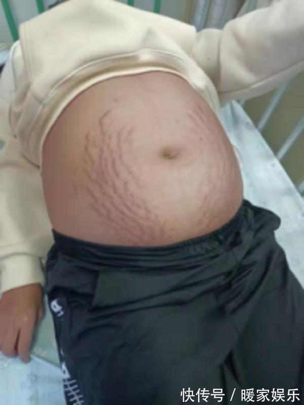 囊肿|13岁女生肚子隆起爬满“妊娠纹”，照完CT妈妈当场吓懵