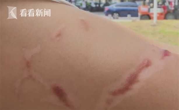 店方|拔火罐操作失误 顾客二度烧伤！店方：技师跑了