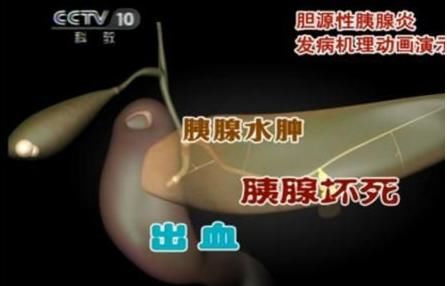 金钱草|胆结石一定要做手术？先看“5种”自然治疗方法