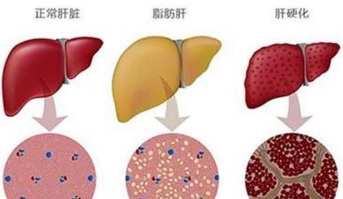 中医|脂肪肝，肝硬化怎么办中医：少吃4物，多吃它肝会“感激”你