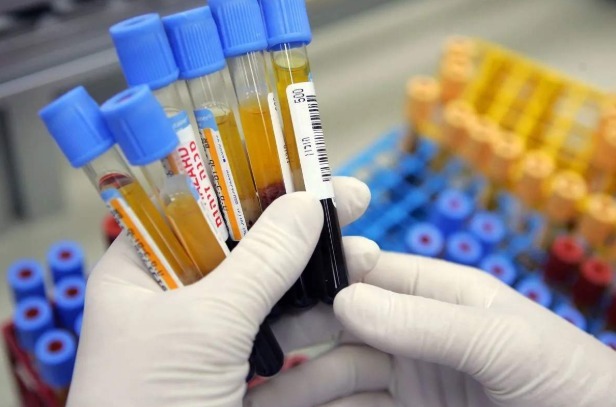 血液循|45岁大妈查出高血脂，引发脑梗，医生无奈2种素食，血脂升得快