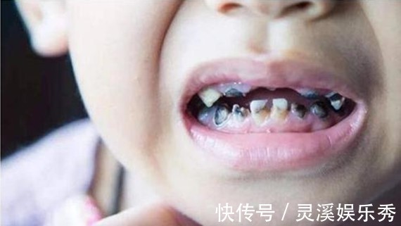 小黑牙|3岁孩子满嘴”小黑牙“!医生怒斥:不是糖果,是家长太无知!