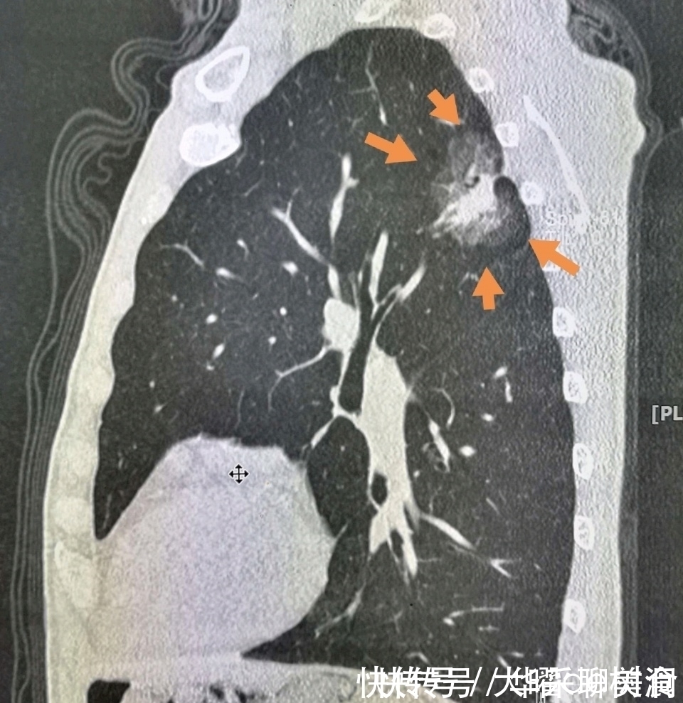 体检|年年体检,为什么还得了晚期肺癌?体检有啥用!