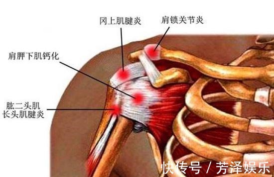 疼痛期|肩膀经常痛3个动作自测肩周炎,4个拉筋动作告别肩周炎