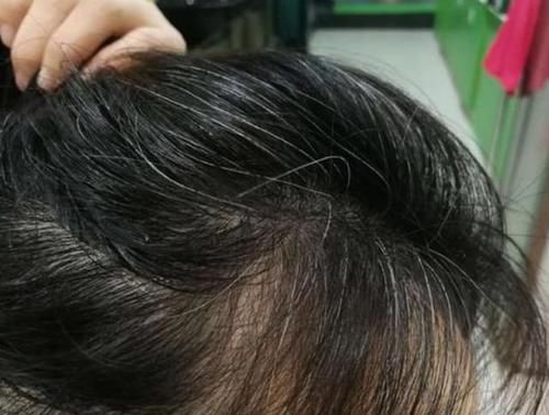 为什么总有人少年白发?黑芝麻真的能让头发变黑吗?一起了解一下