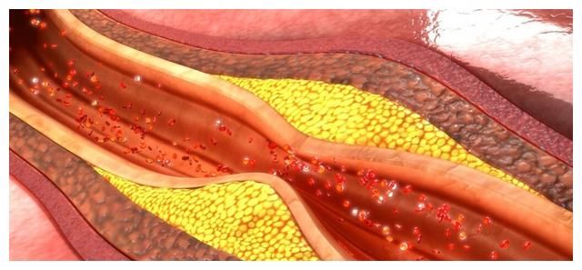 吃他汀降血脂，为什么还是降不到标准？做错两件事，血脂难控制