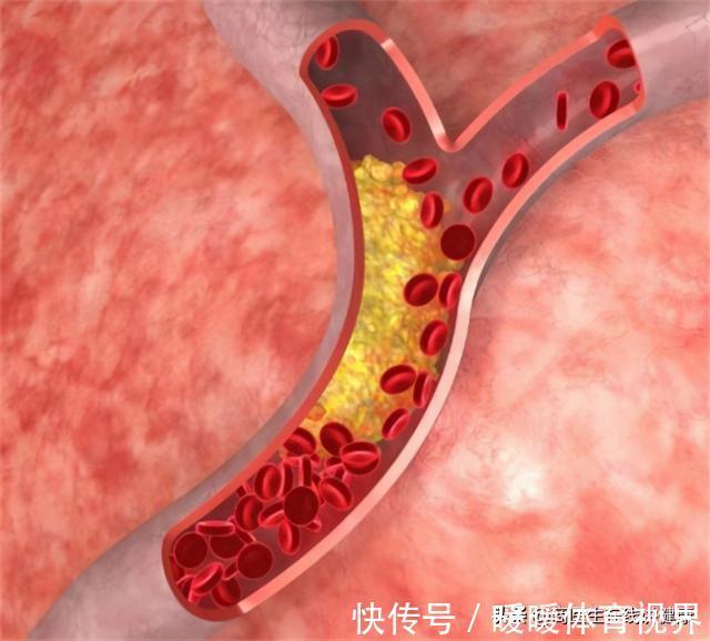 大爷|有高血压的人要注意了，医生：出现这3种状况当心脑出血，要警惕