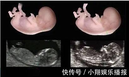 b超|孕妈必知的NT检查, 一篇文章给你讲透咯