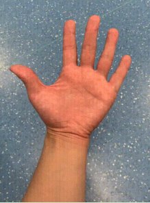 桡骨茎突狭窄性腱鞘炎|“妈妈手”是怎么形成的？它可不是妈妈的专利