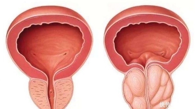 前列腺感染|前列腺问题频发,保护它已迫在眉睫!5个实用妙招,男性一定要看