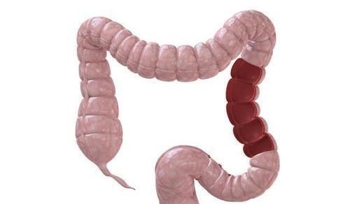 癌肿|排便不畅,是肠癌吗?医生:符合3个标准,尽早去医院检查一下