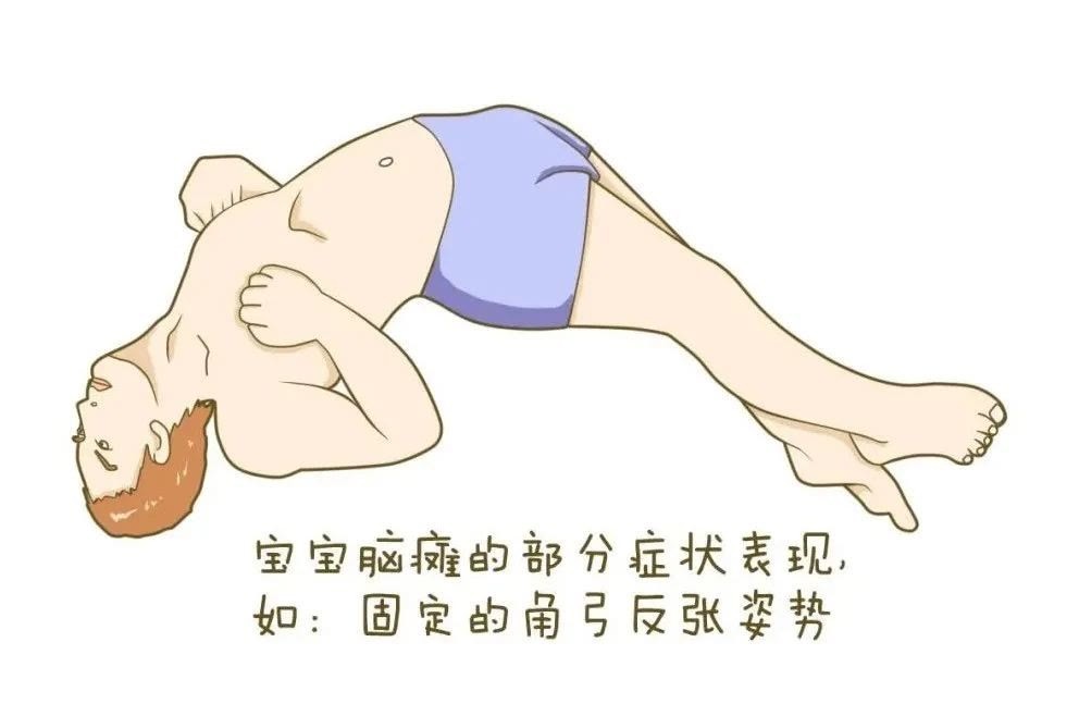 高危因素|导致脑瘫发生的高危因素有哪些?