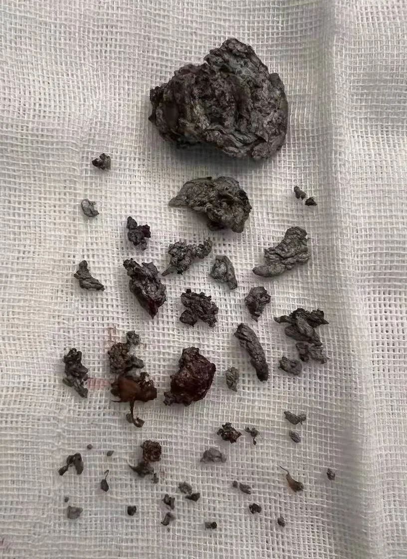 血管|660℃铝液喷溅,一男子颈总动脉中招!剥离出50多块铝块