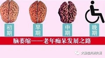 小脑萎缩|小脑萎缩分为早中晚期,每期的症状呈加重趋势