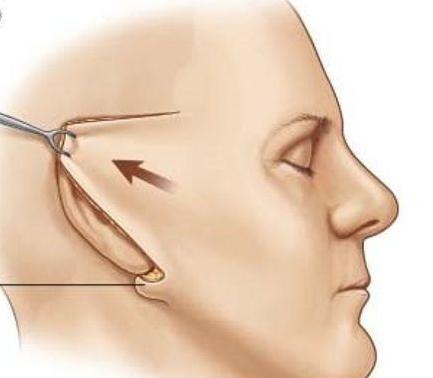 拉皮手术 拉皮术后即刻,47岁的我找回了消失已久的“少女感”!