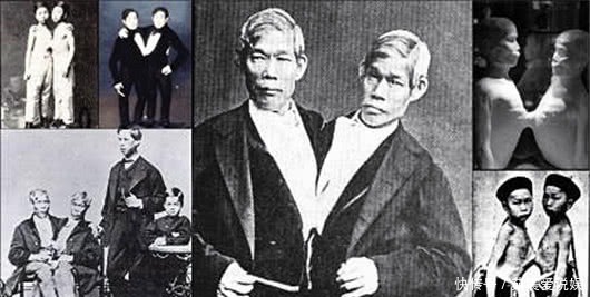 敬仰|中国2名连体双胞胎,娶英国两姐妹为妻,死后受人敬仰