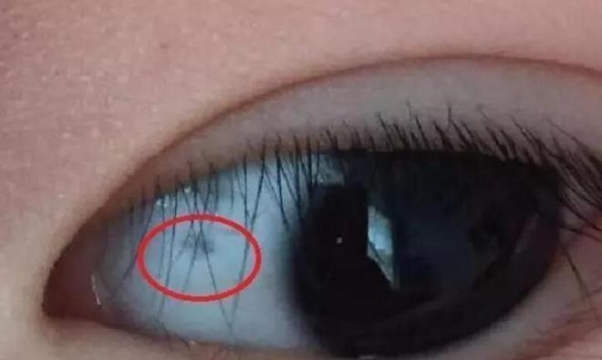 眼白|3岁宝宝眼白出现黑点,怎么回事儿听了医生的答案,终于放心了