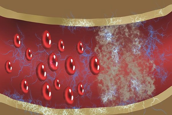 回事|孕妈妈出现静脉血栓是怎么回事？能预防吗？