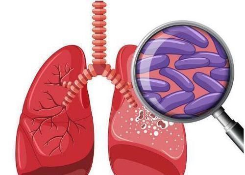 肺癌|肺癌到了晚期,4个变化很明显,骗不了人,别大意了