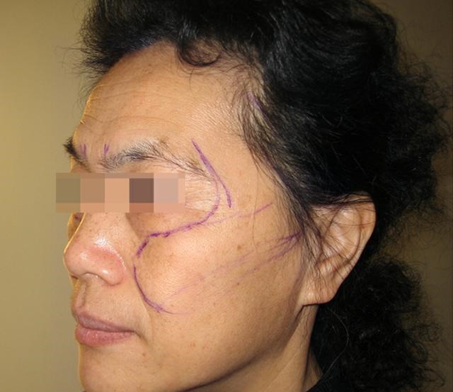 拉皮手术 拉皮术后即刻,47岁的我找回了消失已久的“少女感”!