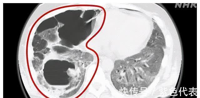 肺部|日本新冠患者2个月的治疗过程 挣扎在生死边缘