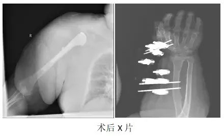 电击伤|完美置换，肩复使命