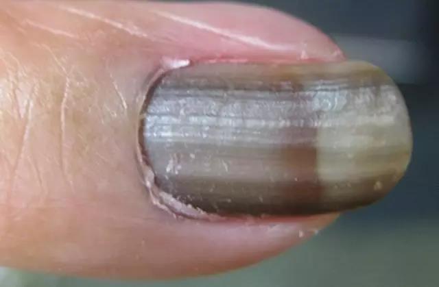 医生|指甲上有黑线,可能是最恶的癌症,医生教你怎么办