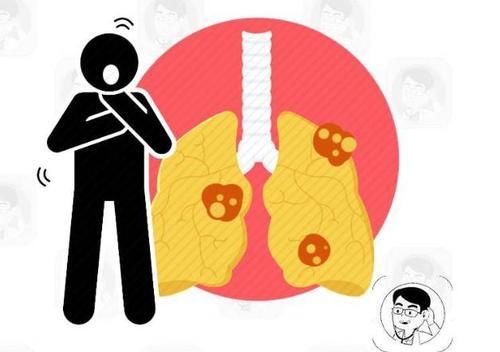  早期|肺癌本可治，重在早发现！早期肺癌的6个信号，你不可不知