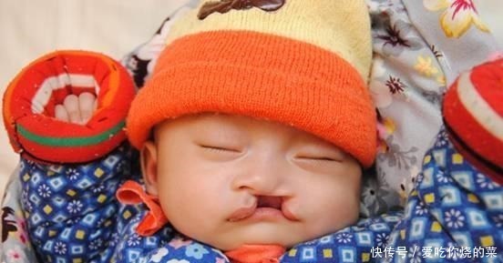 唇裂|30岁孕妇怀双胎查出唇腭裂,不舍得打掉,看到宝宝全家乐开花!