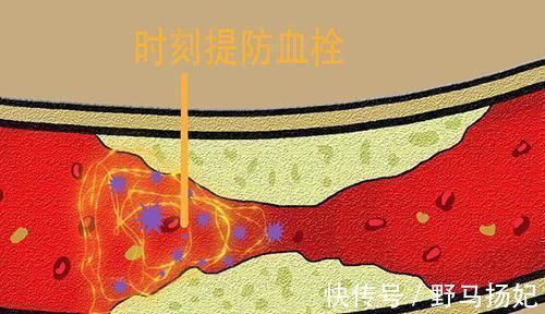 阿司匹林|终于找到食物中的“阿司匹林”，适当吃一点，血管中的血栓全消光