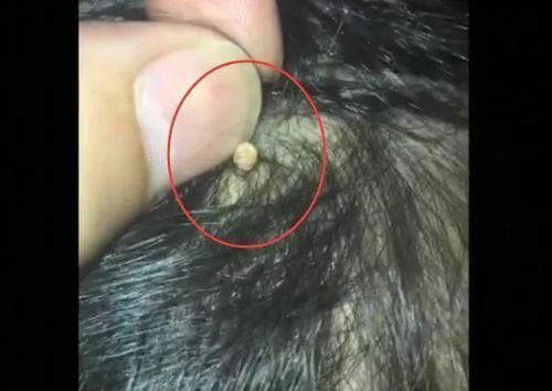 检查|爸爸给女儿梳头时发现“白米粒”,送医院后,检查结果让宝爸后怕