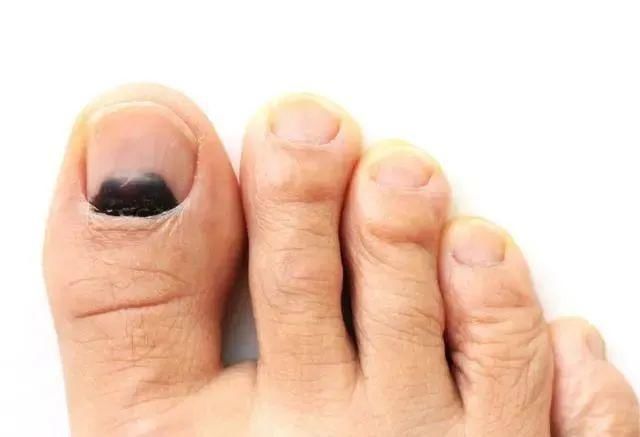 高血糖|血糖超标,“脚”知道?双脚若没有4异常,祝贺,血糖控制得不错