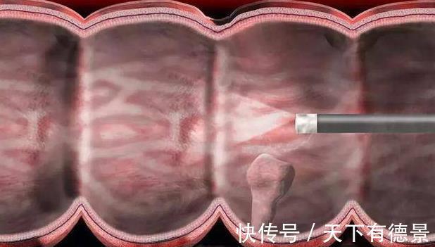 乳腺纤维瘤|三个良性肿块必须及时切除，延迟就会变成恶性肿瘤！你清楚吗？