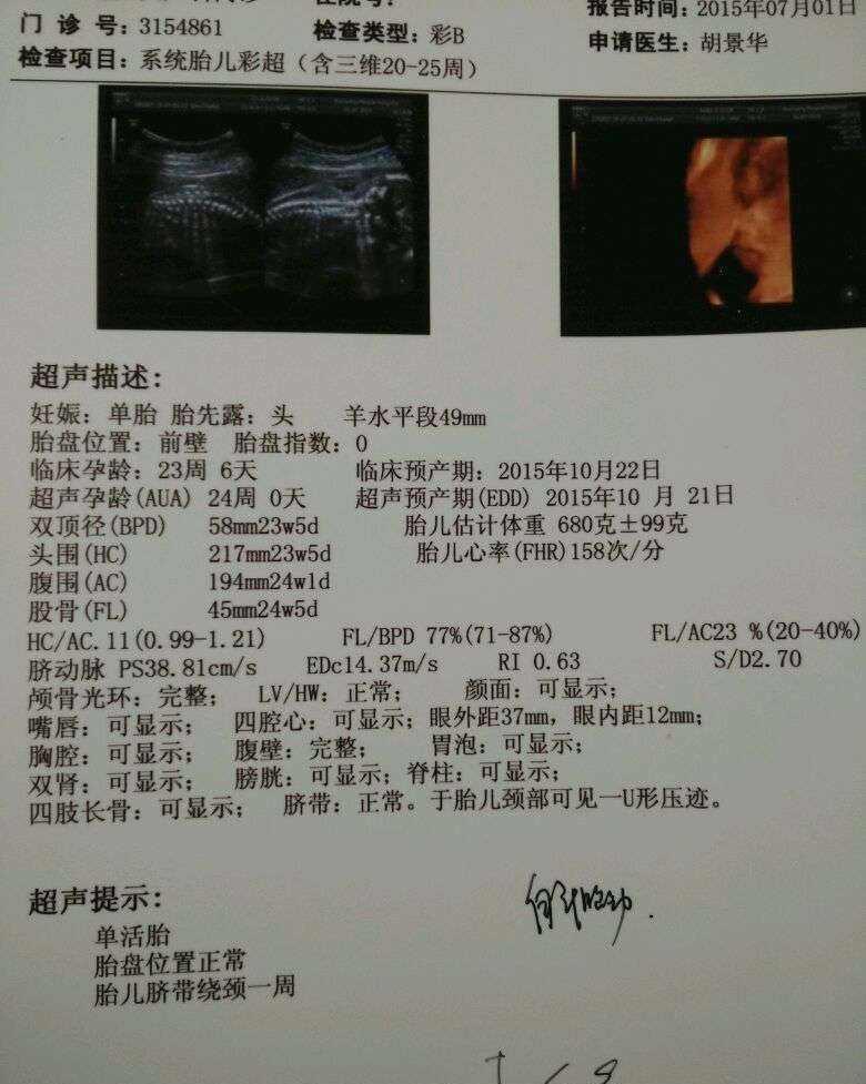 纠正|脐带绕颈不可怕,怕的是孕妈这3个“坏习惯”,不及时纠正会加重