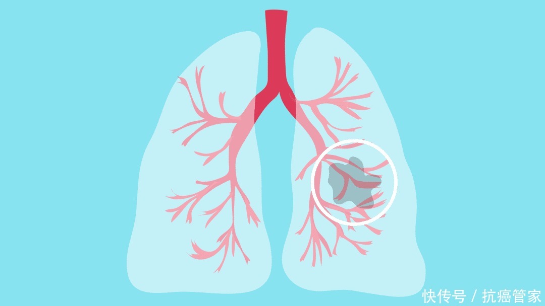  更好|三甲医院治肺癌疗效更好的原因找到了！揭示肺癌治疗新模式