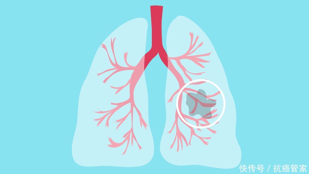 更好|三甲医院治肺癌疗效更好的原因找到了!揭示肺癌治疗新模式