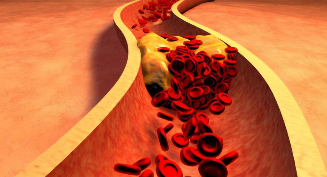 血液粘稠|高血脂的祸根被发现,这3物,多吃一口都是在“涨”血脂,劝少吃