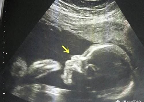 鼻骨|孕23周＋2四维显示无鼻骨，做唐筛NT低风险，孩子能留吗？