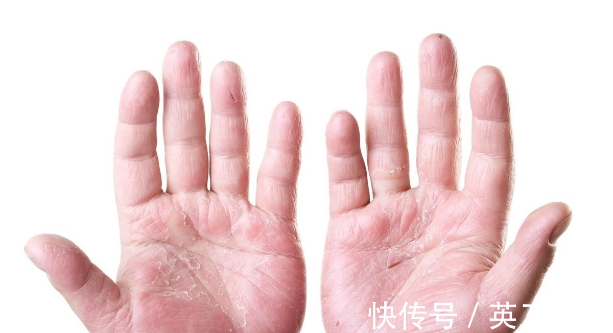 肝功能|手掌胸部出现这些表现,立即去医院查查肝,是肝硬化的前期表现