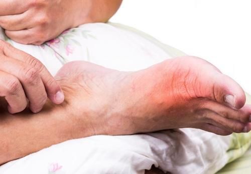 海鲜|海鲜是痛风的“发物”？尿酸高的人，“4鱼1豆”要少碰