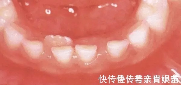 乳牙|家长必读权威专家提醒：必须在12岁前处理的10种儿童牙颌畸形