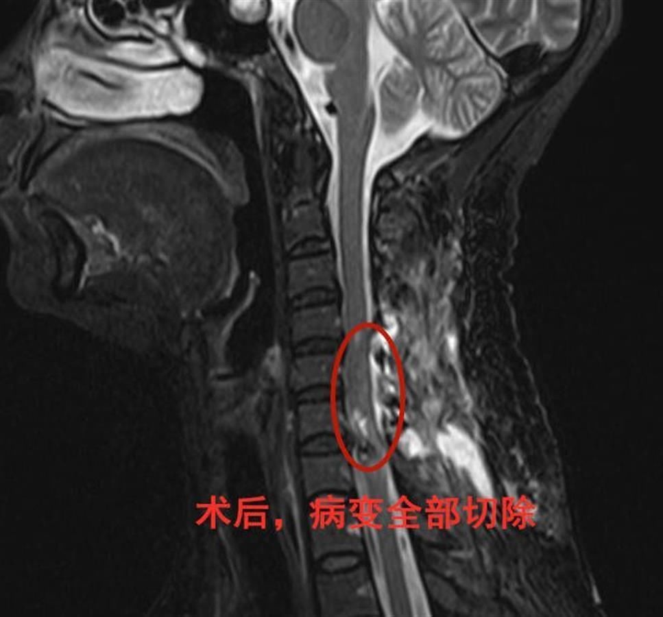 神经外科|女子突发肢体麻木乏力 “真凶”竟是脊髓肿瘤