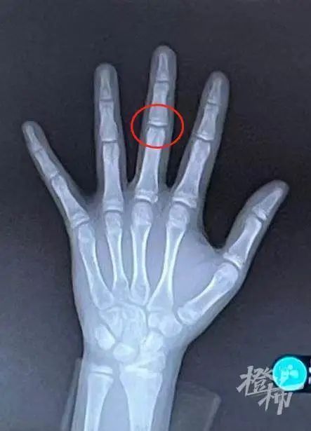 发育|暑假“测骨龄”的娃乌泱泱!儿科专家提醒:要小心