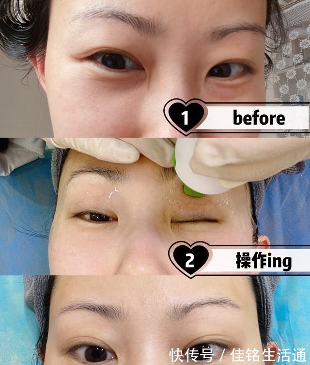 周大 花同样的钱做眼部热玛吉值得吗丨眼部热玛吉初体验!