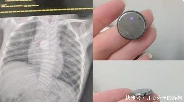 家长们|6岁女儿突然暴瘦,拍片检查时医生让摘下项链,妈妈:哪有项链?