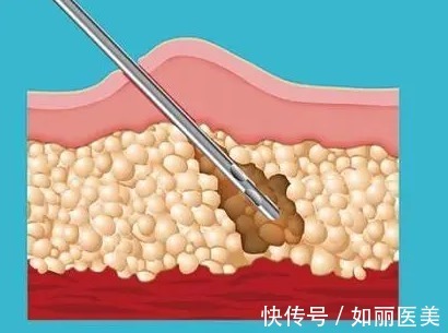 医生 抽脂手术大概花多少钱？附价格表2022一览+危害盘点！