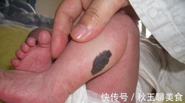 胎记|18岁女孩因为脸上的胎记,选择结束生命,胎记到底是怎么形成的