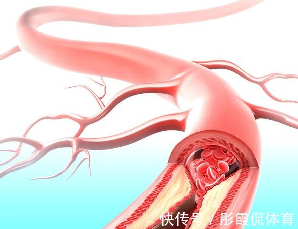 高脂血症|98岁中医，血管再堵，用对这个方法，快速解决高血脂，用1个好1个