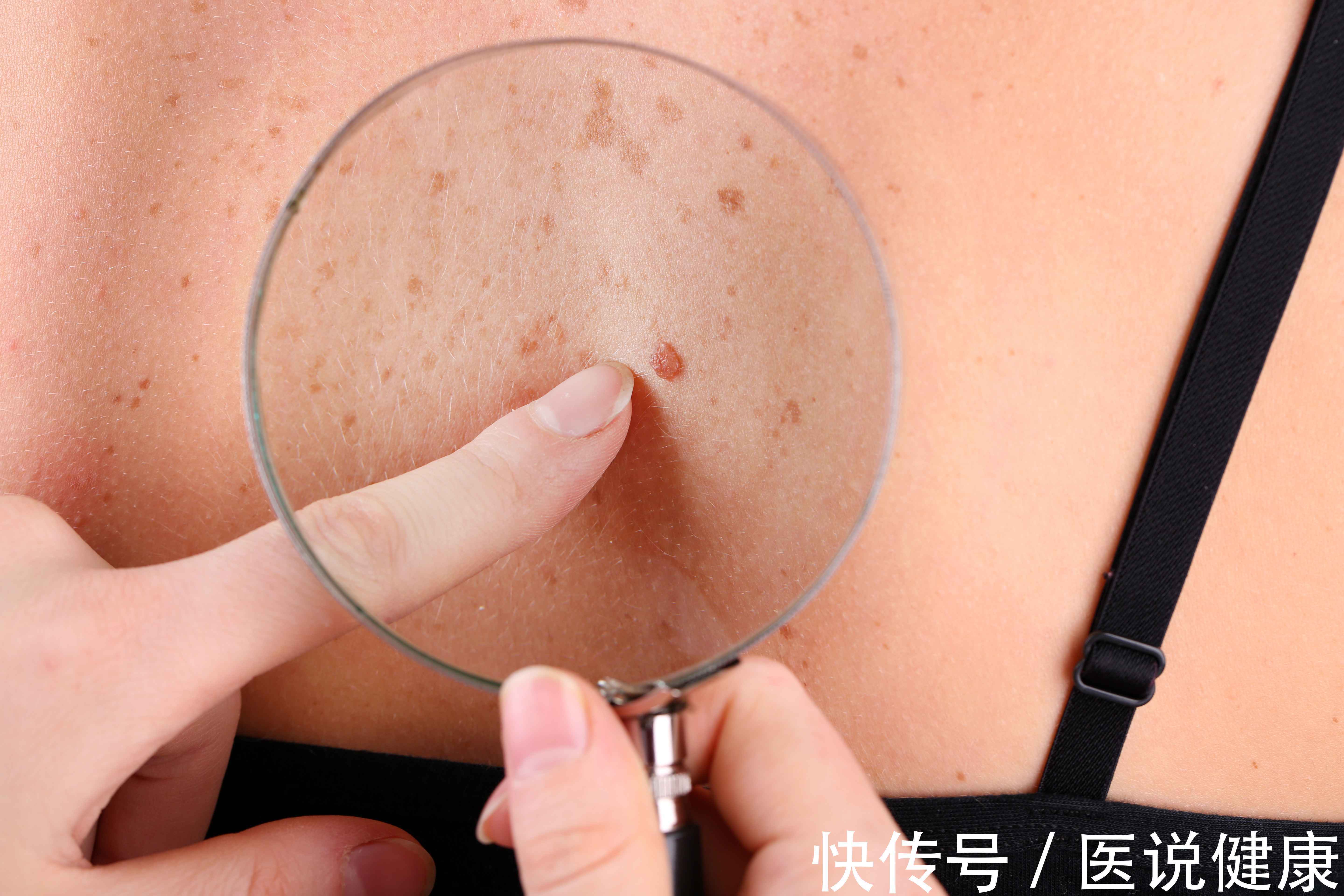 蜘蛛痣|肝病发生前,身体或出现这5种不适,发现后,及时检查,控制病情