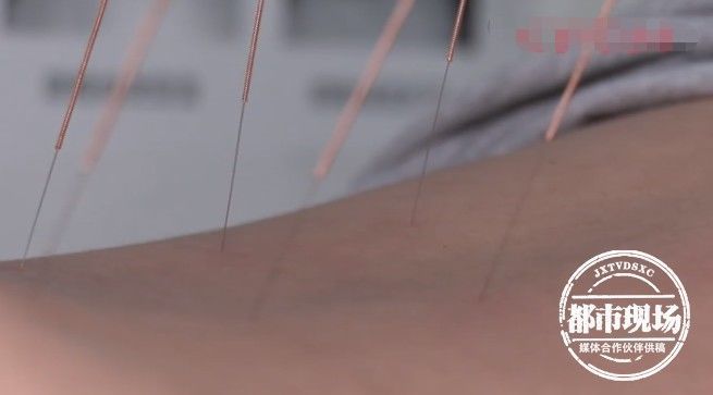 梁婆婆|67岁老人自行针灸,针断腹中!她又想自己开口子取出